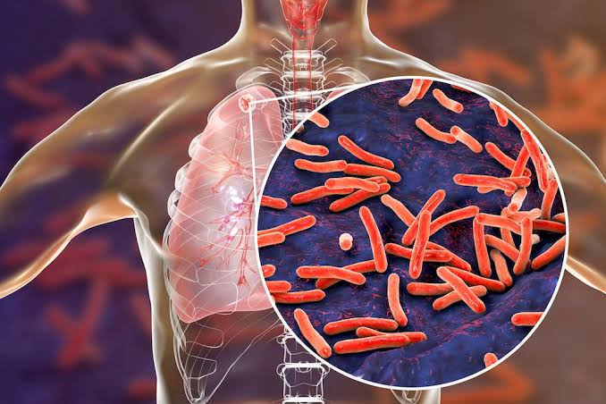 Tuberculosis (TB)